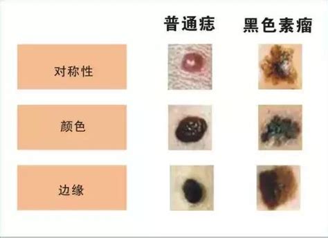 陰莖長痣|陰囊上的痣：正常嗎？該去看皮膚科嗎？